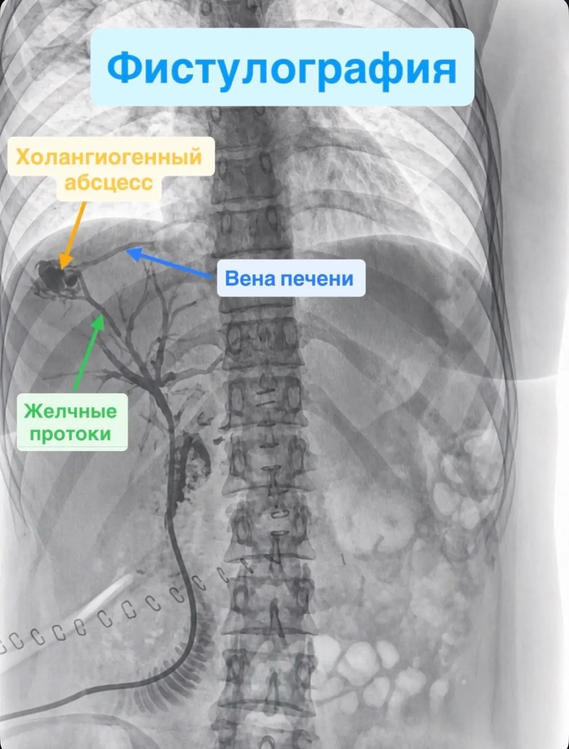 Пациентка краевой больницы сама спаслась от грозящего ей сепсиса Пациентка краевой больницы сама спаслась от грозящего ей сепсиса