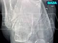 Мастер акупунктуры нашпиговал ногу жительницы Красноярска обломками игл