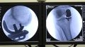ХИРУРГИ БСМП ОСВОИЛИ ВЫСОКОТЕХНОЛОГИЧНУЮ ОПЕРАЦИЮ КОЛЕННОГО СУСТАВА