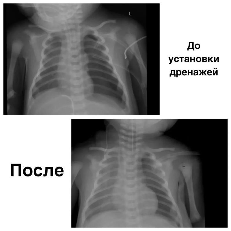 Счёт шёл на минуты: красноярские врачи спасли новорождённого в критическом состоянии Счёт шёл на минуты: красноярские врачи спасли новорождённого в критическом состоянии